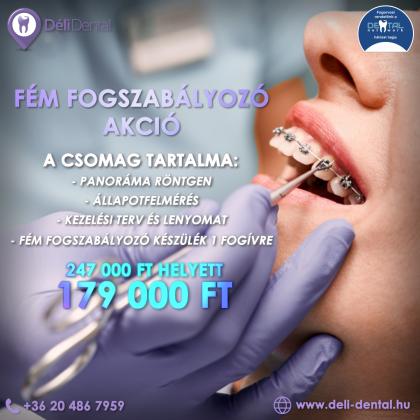 Fém Fogszabályozó Akció Fém Fogszabályozó Akció