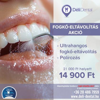Fogkő Eltávolítás AKCIÓ