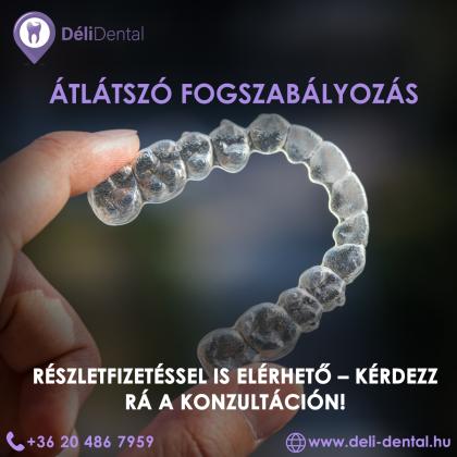 Átlátszó fogszabályozás részletfizetéssel