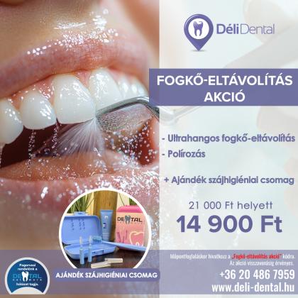 Fogkő Eltávolítás AKCIÓ