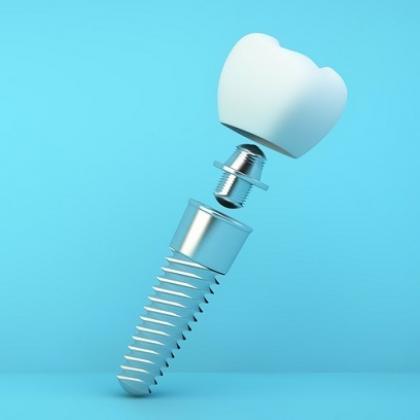 Az implantáció nem mumus és megfizethető Az implantáció nem mumus és megfizethető
