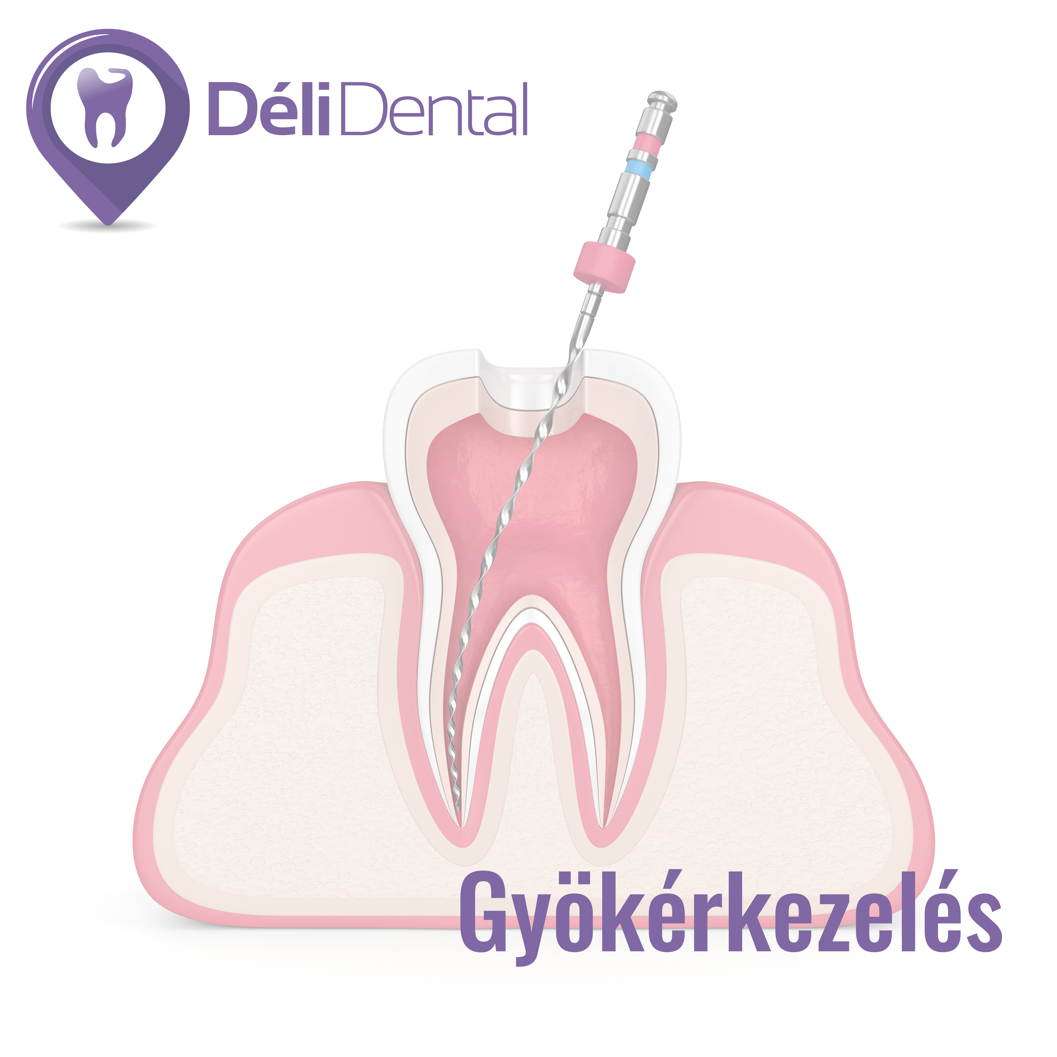 Гибкие эндодонтические инструменты. Этапы эндодонтического лечения. Осложнения эндодонтических вмешательств. Эндодонтические вмешательства. Эндодонтические вмешательства.